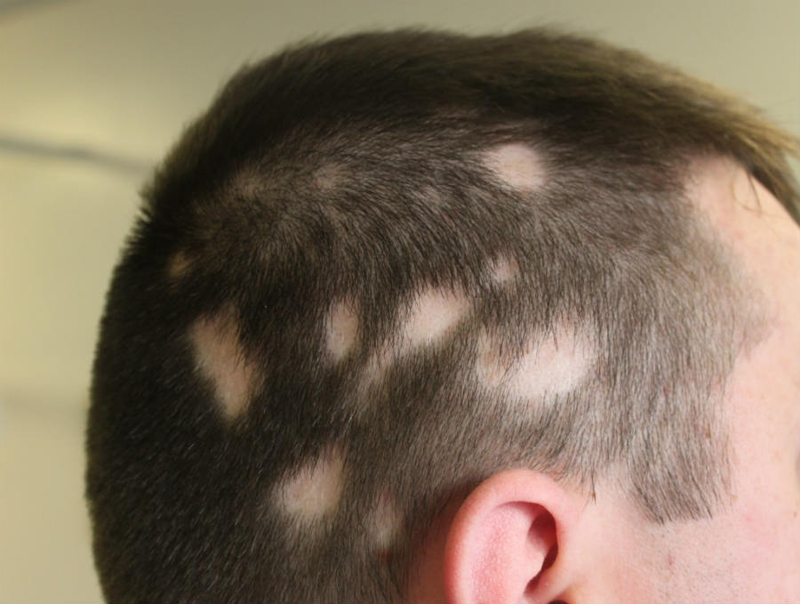 Hair Loss (Alopecia) – Possible Causes