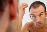 Hair Loss Treatment from a Glaucoma Drug