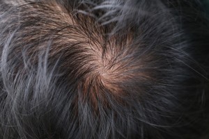 New Study Shows Hair Loss Reversed in Alopecia Areata Sufferers