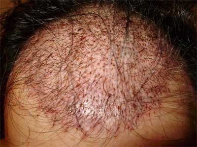 After Hair Transplant Surgery