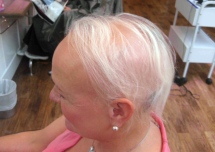 Specialist treatment provides confidence boost to sufferers of alopecia devastation