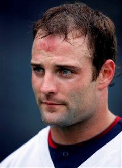 Patriots wide receiver Welker has hair transplant