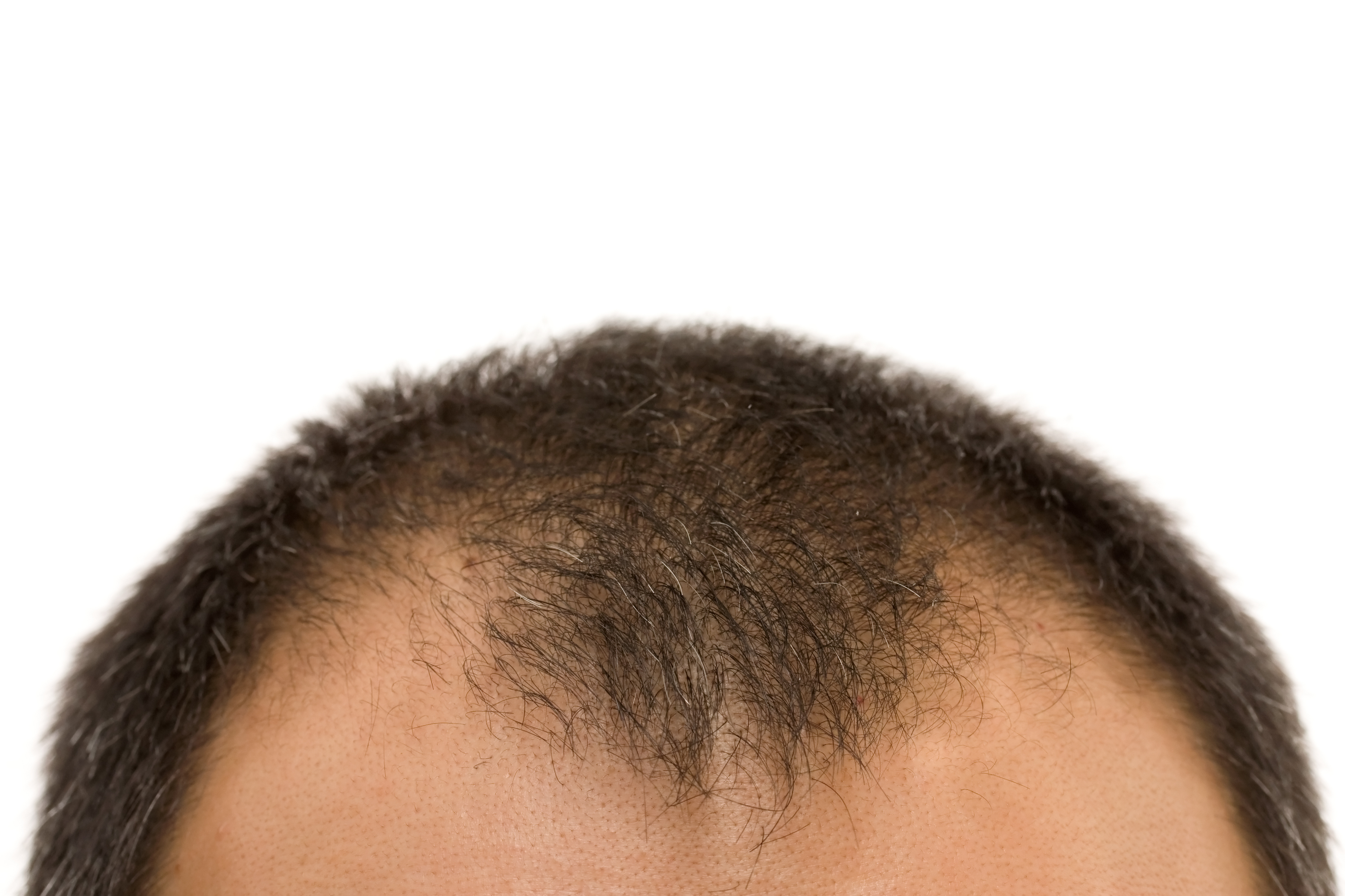 Cure for Male Pattern Baldness - Androgenic Alopecia - Regrowth